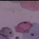 Κοιλοκυττάρωση